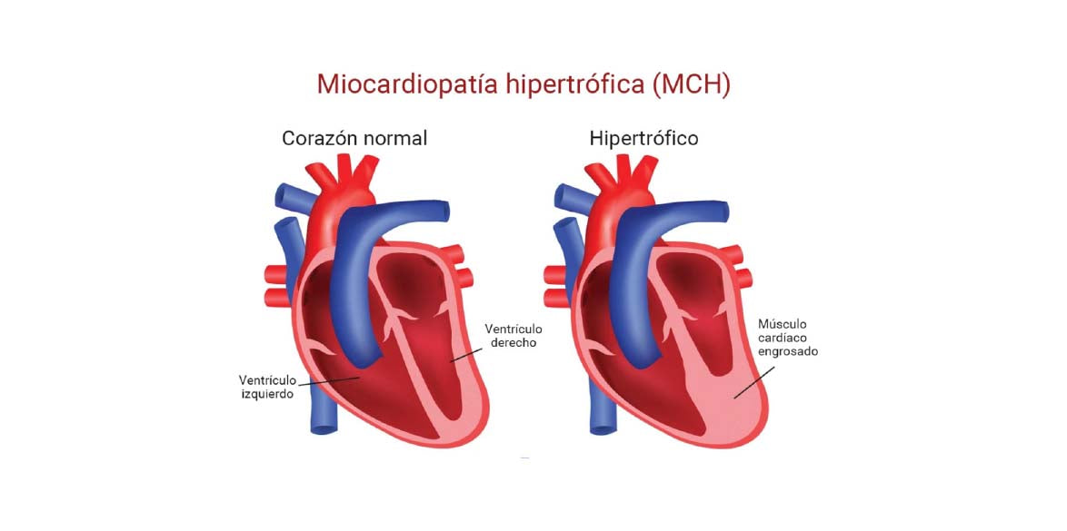 Síndrome del Corazón del Atleta